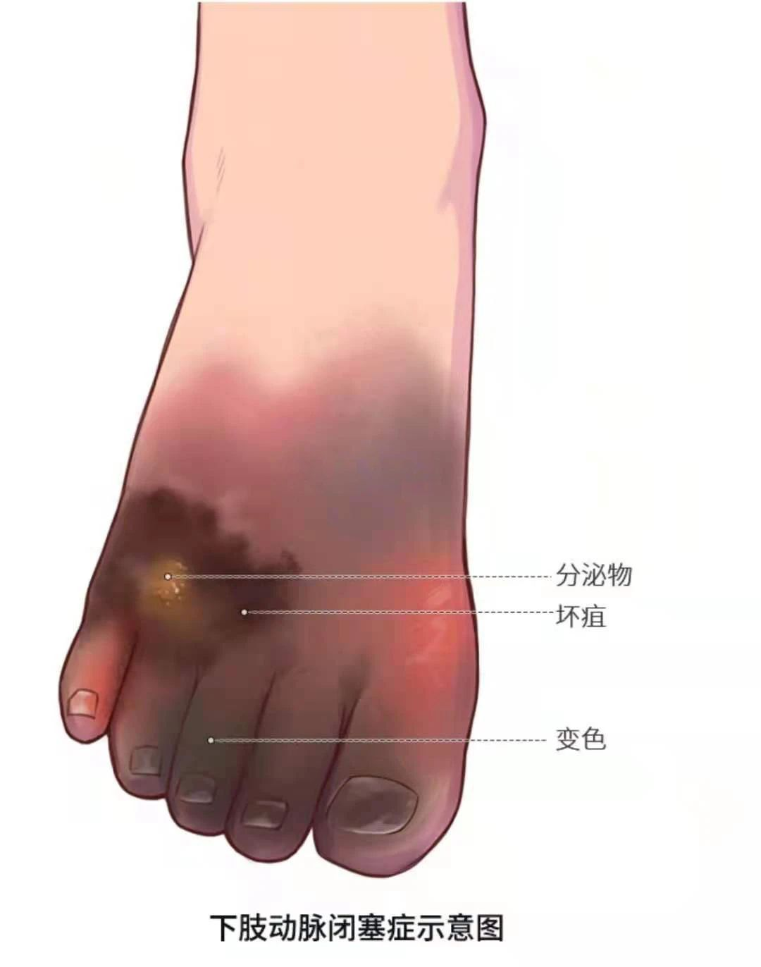 深靜脈血栓類(lèi)似病癥的認(rèn)識(shí)與區(qū)分