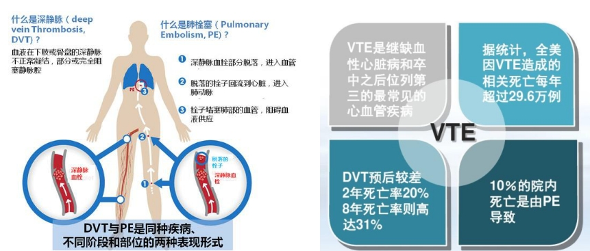 VTE的危害您了解嗎？