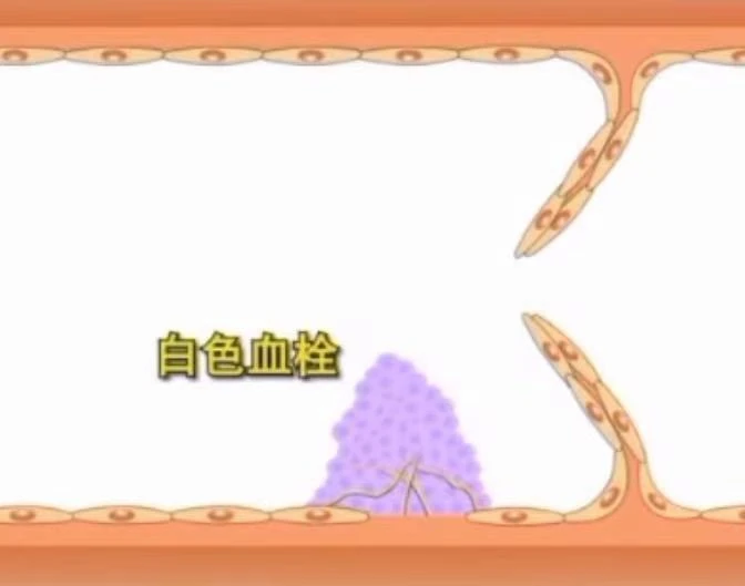 世界血栓日來(lái)臨之際 共話血栓的前世今生